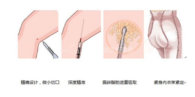 腿部吸脂手术过程