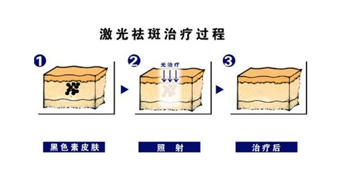 激光祛斑